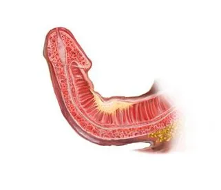 Ilustração de um órgão interno com tecido vermelho e amarelo visível — Doença de Peyronie