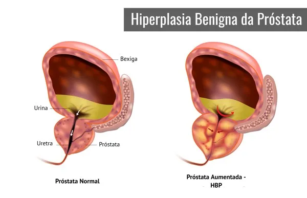 Hiperplasia Benigna da Próstata — Clínica do Poder