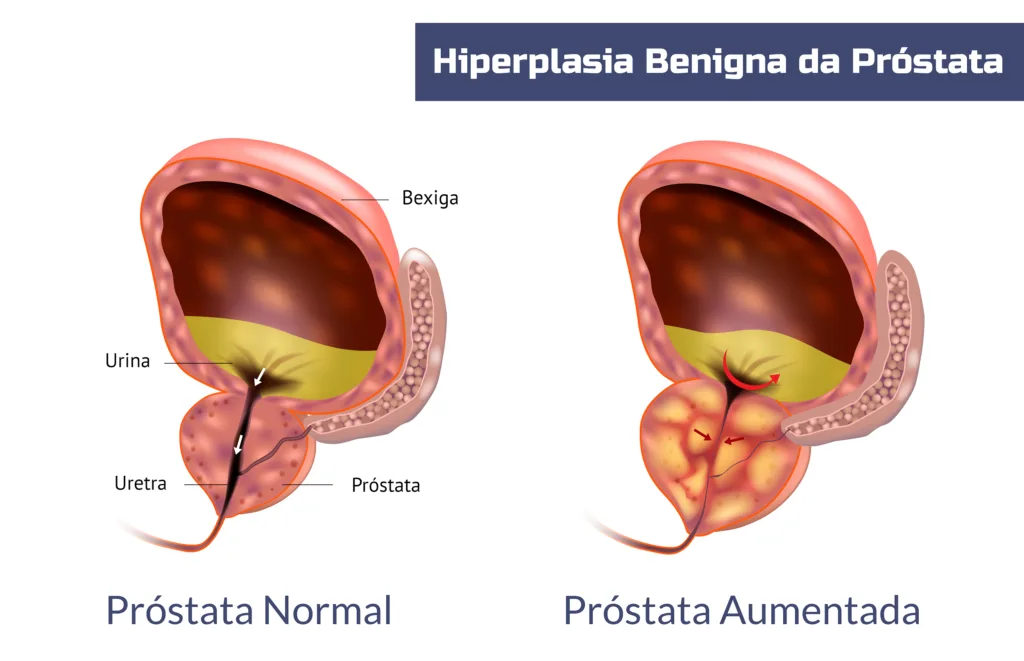 Diagrama comparativo de próstata normal e aumentada com rótulos anatómicos — Ter HBP não significa perder a virilidade
