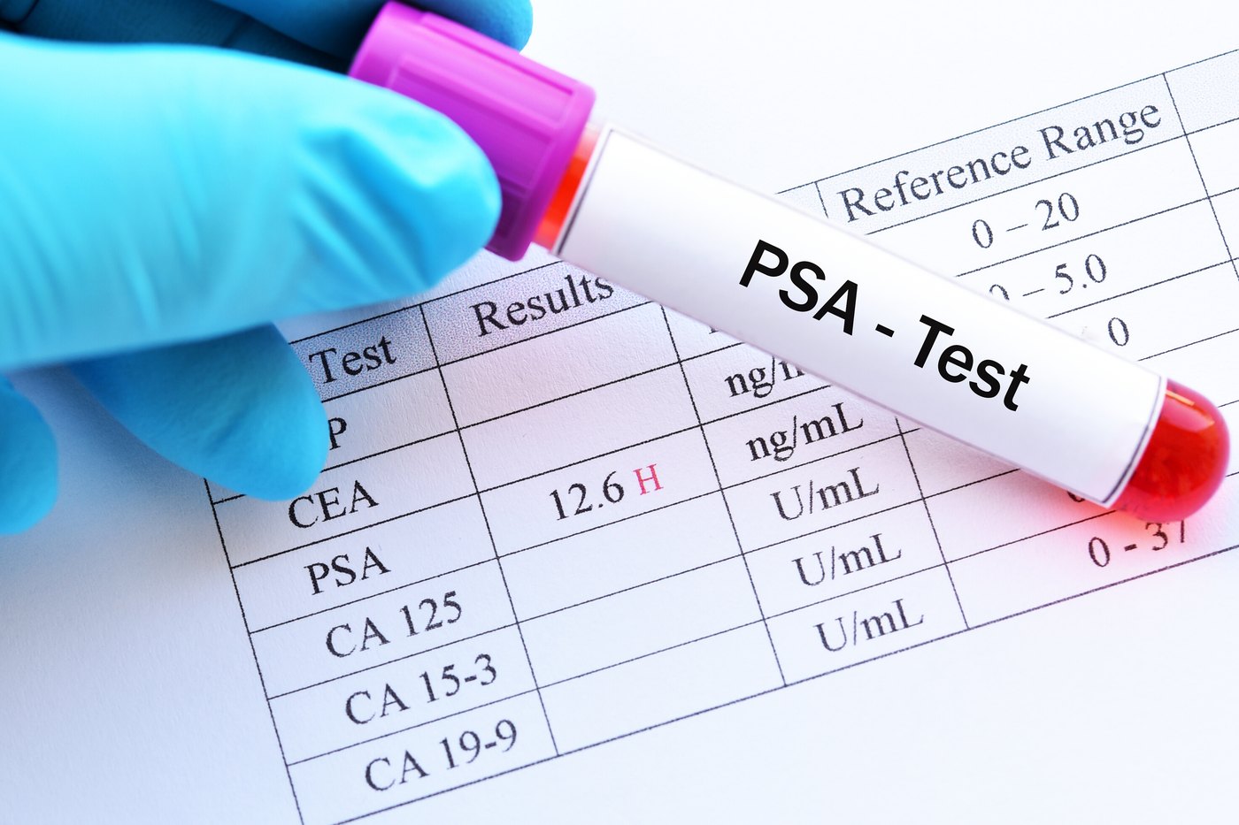 Os níveis normais de PSA situam-se abaixo de 4 ng/ml