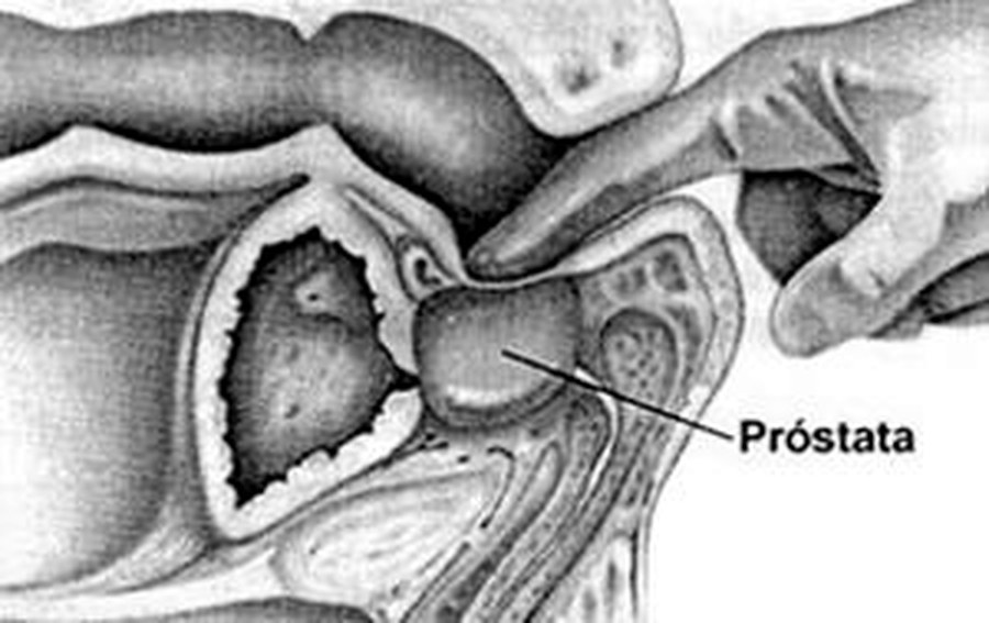 Toque rectal