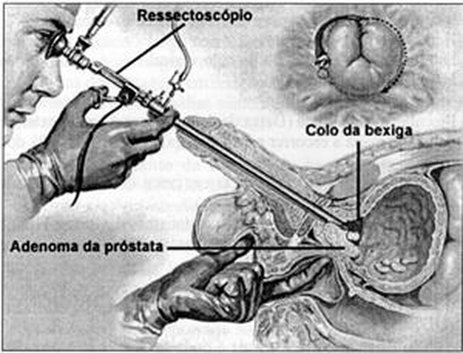 Ressecção transuretral da próstata