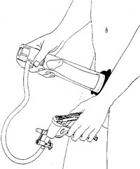 Representação de utilização da prótese externa de vácuo (modelo manual) B