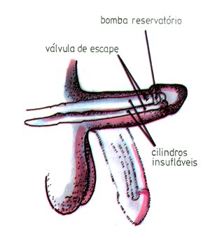 Representação do funcionamento com Dynaflex - prótese Hidráulica
